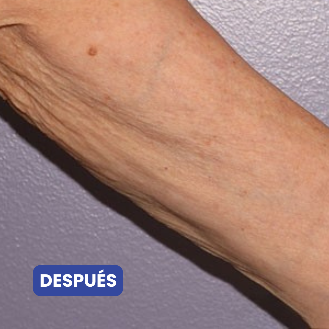 Crema Corporal Para Mejorar la Apariencia de Brazos