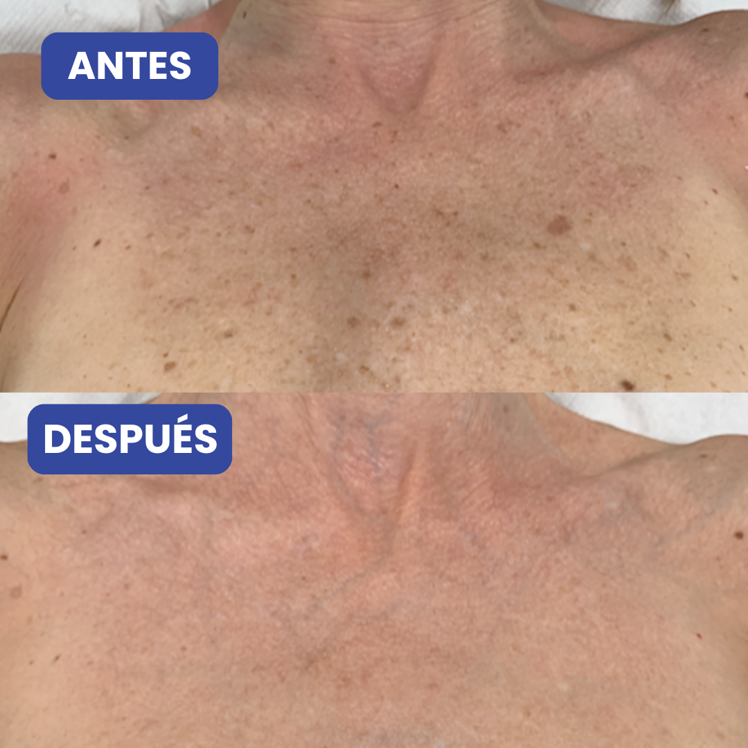 Crema Dermoaclarante para el Cuello